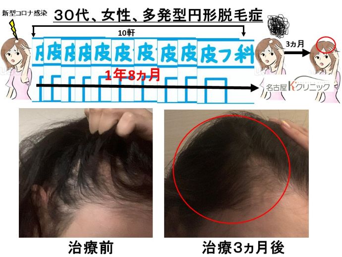 円形脱毛症　病院